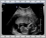 sonogram 5 weeks. See more ultrasound - 5 weeks