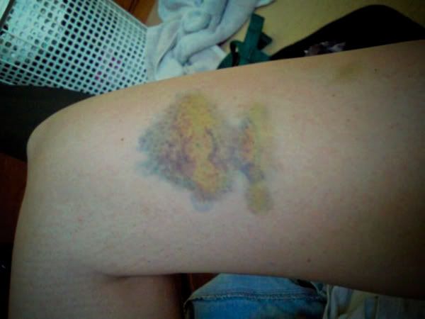 bruise3.jpg