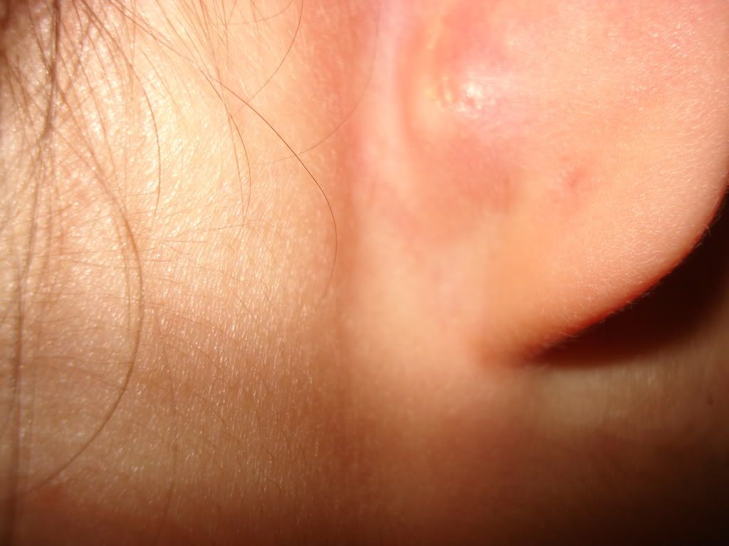 Swollen Behind Ear