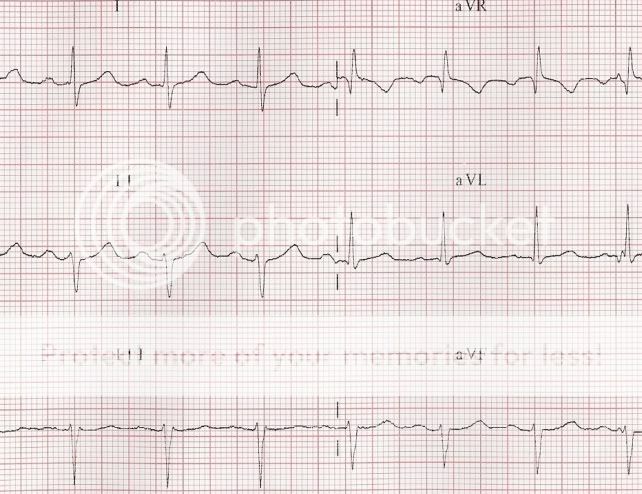 12 Lead EKG interpretations: let's do it!!! | EMTLIFE